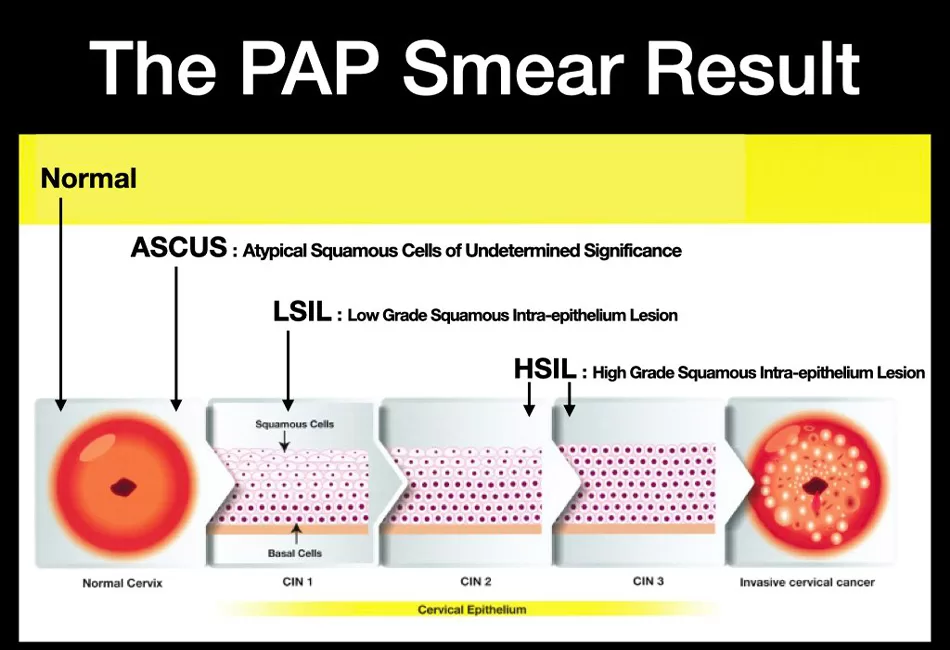 Kết quả xét nghiệm Pap Ascus