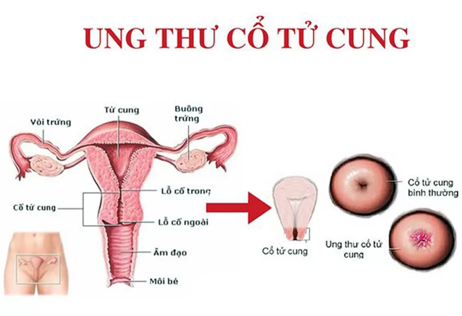 ung thư cổ tử cung