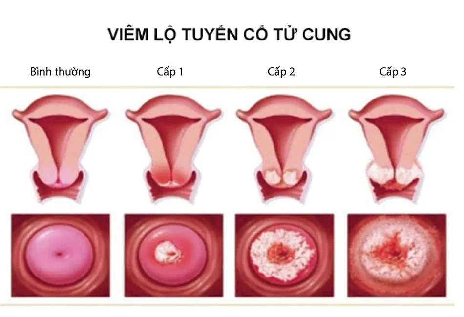 các cấp độ của viêm lộ tuyến cổ tử cung