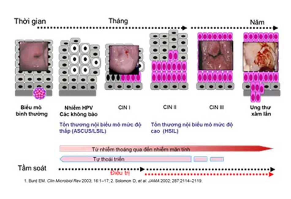 tiến triển của ung thư cổ tử cung 