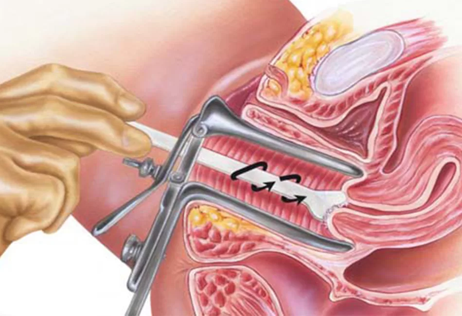 xét nghiệm tế bào học cổ tử cung (Pap test)