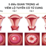 europharm vn viêm lộ tuyến cổ tử cung