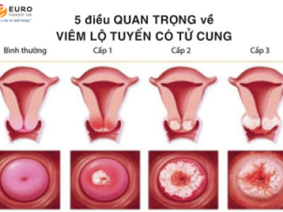 5 điều quan trọng về VIÊM LỘ TUYẾN CỔ TỬ CUNG bạn cần biết!