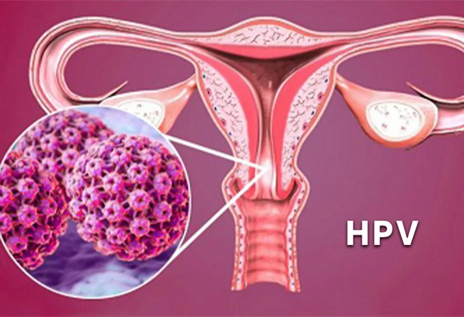 HPV là nguyên nhân gây biến đổi tế bào cổ tử cung