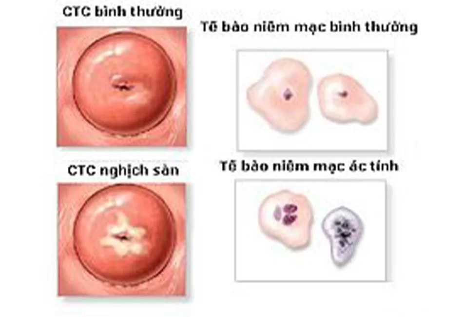 Tế bào cổ tử cung bất thường