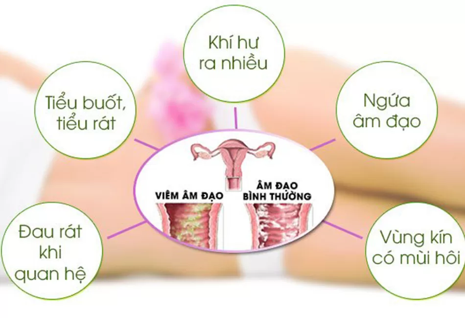 dấu hiệu viêm âm đạo tái phát