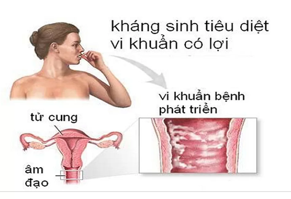 lý do khiến viêm âm đạo tái phát