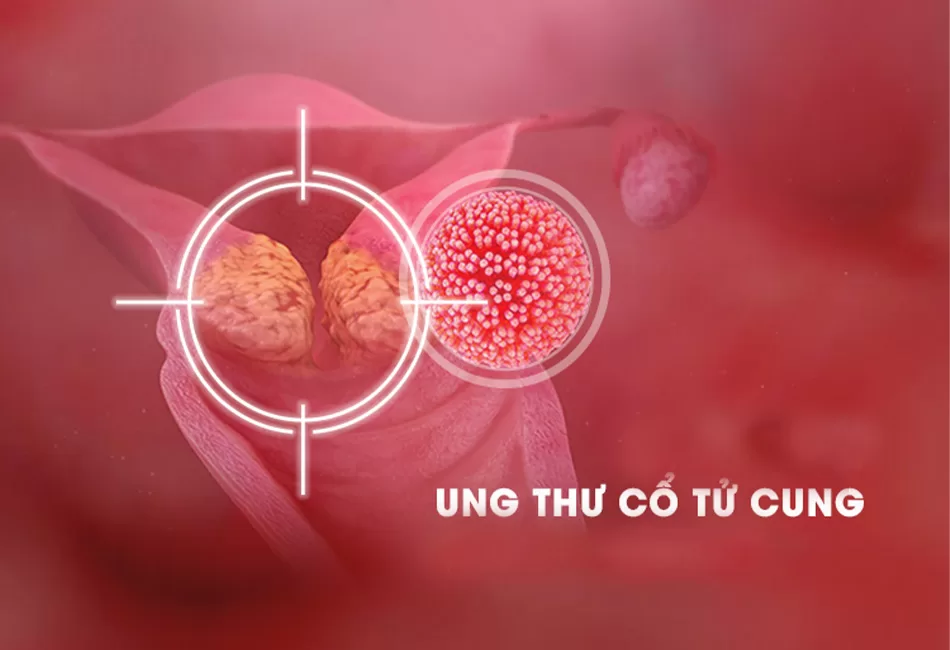 ung thư cổ tử cung và Hsil