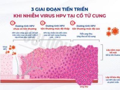 Nhiễm HPV ở cổ tử cung: cách nào giúp cơ thể đẩy nhanh khả năng tự đào thải HPV?