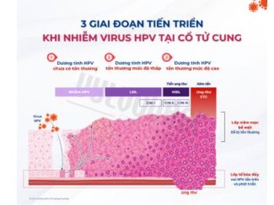 Nhiễm HPV ở cổ tử cung: cách nào giúp cơ thể đẩy nhanh khả năng tự đào thải HPV?