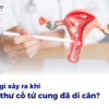 Điều gì xảy ra khi ung thư cổ tử cung đã di căn?