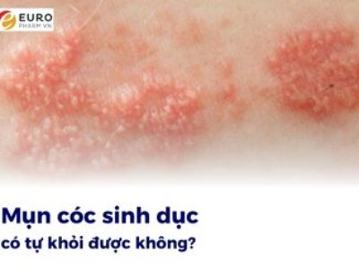 Mụn cóc sinh dục có tự khỏi được không?