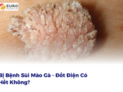 Bị Bệnh Sùi Mào Gà – Đốt Điện Có Hết Không?