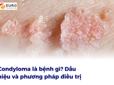 Condyloma là bệnh gì? Dấu hiệu và phương pháp điều trị