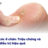 Mụn cóc ở chân là gì?