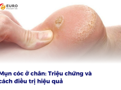 Mụn cóc ở chân là gì?