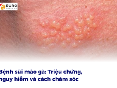 Bệnh sùi mào gà: Triệu chứng, nguy hiểm và cách chăm sóc