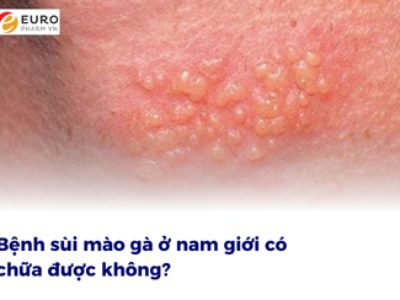 Bệnh sùi mào gà ở nam giới có chữa được không?