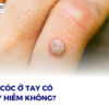 MỤN CÓC Ở TAY CÓ NGUY HIỂM KHÔNG?