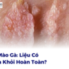 Sùi Mào Gà: Liệu Có Chữa Khỏi Hoàn Toàn?