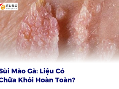 Sùi Mào Gà: Liệu Có Chữa Khỏi Hoàn Toàn?