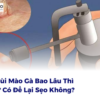 Đốt Sùi Mào Gà Bao Lâu Thì Khỏi? Có Để Lại Sẹo Không?